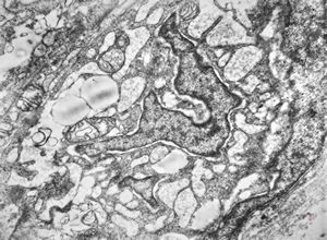 F,12y. | malignant tumor of the orbita - liposarcoma?, neurofibrosarcoma?